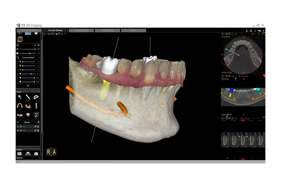 CS Solutions for implants